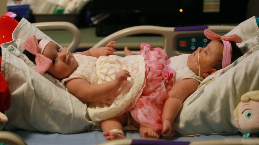 Conjoined Sisters Undergo Rare Separation Surgery In Texas